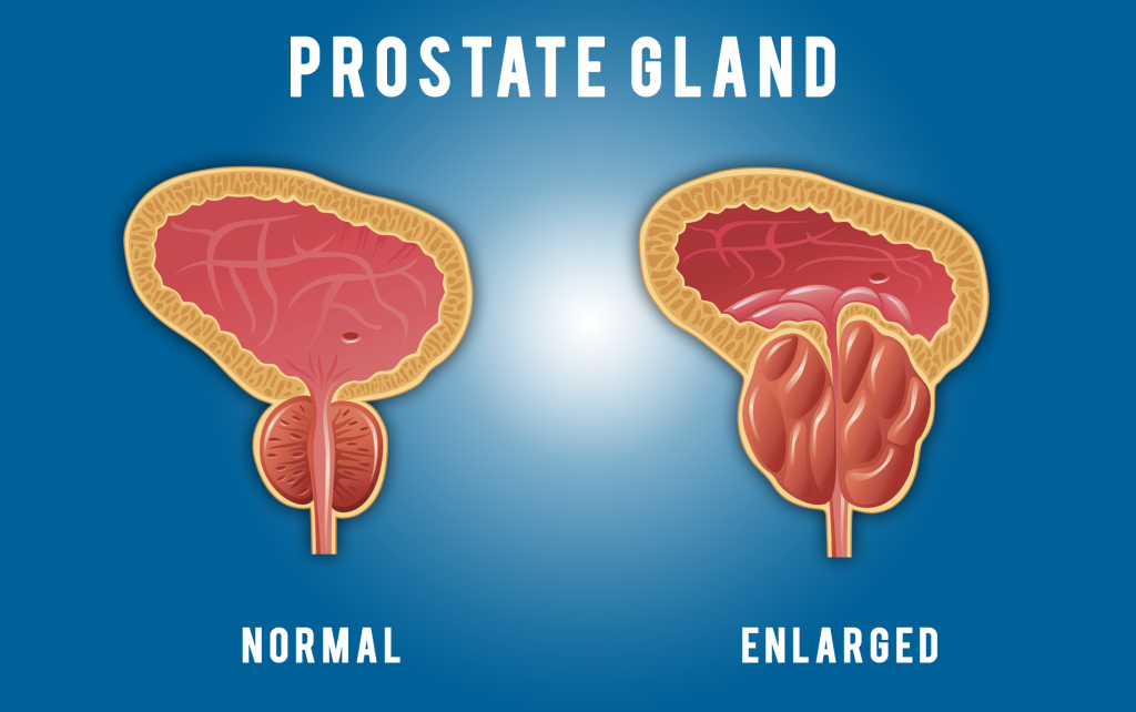 Prostate & Prostate Signs