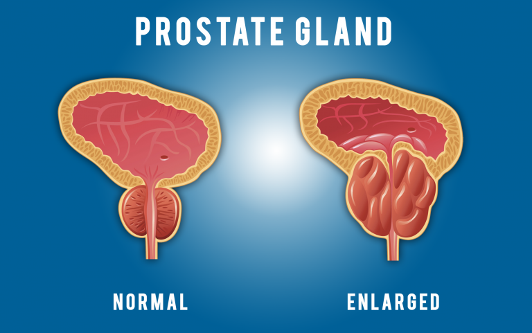 Prostate And Prostate Signs 8988